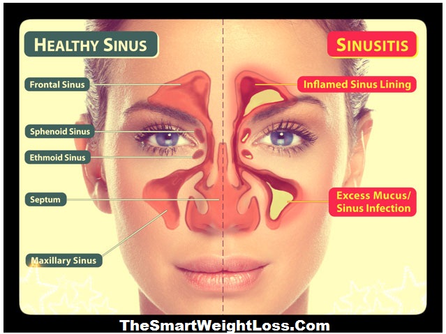 Common Causes of Sinusitis