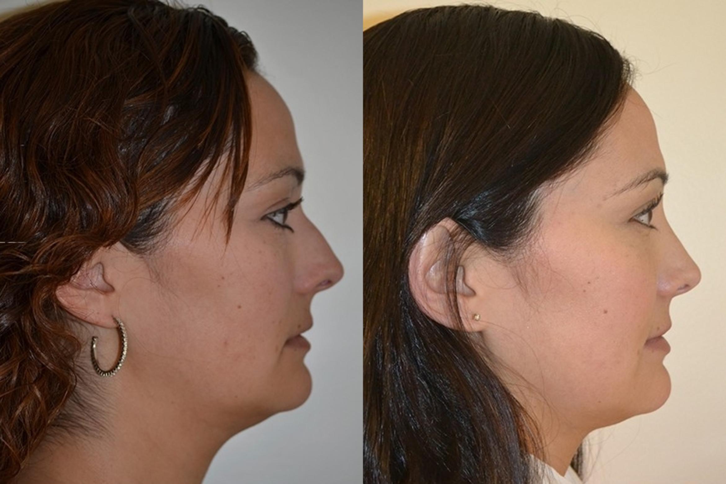 How does a closed rhinoplasty work